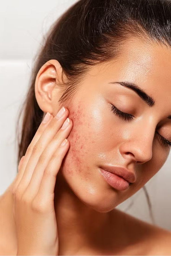 ACNE & BLEMISHES